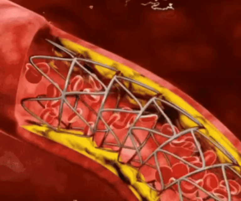 La cause des sciatiques et douleurs de dos