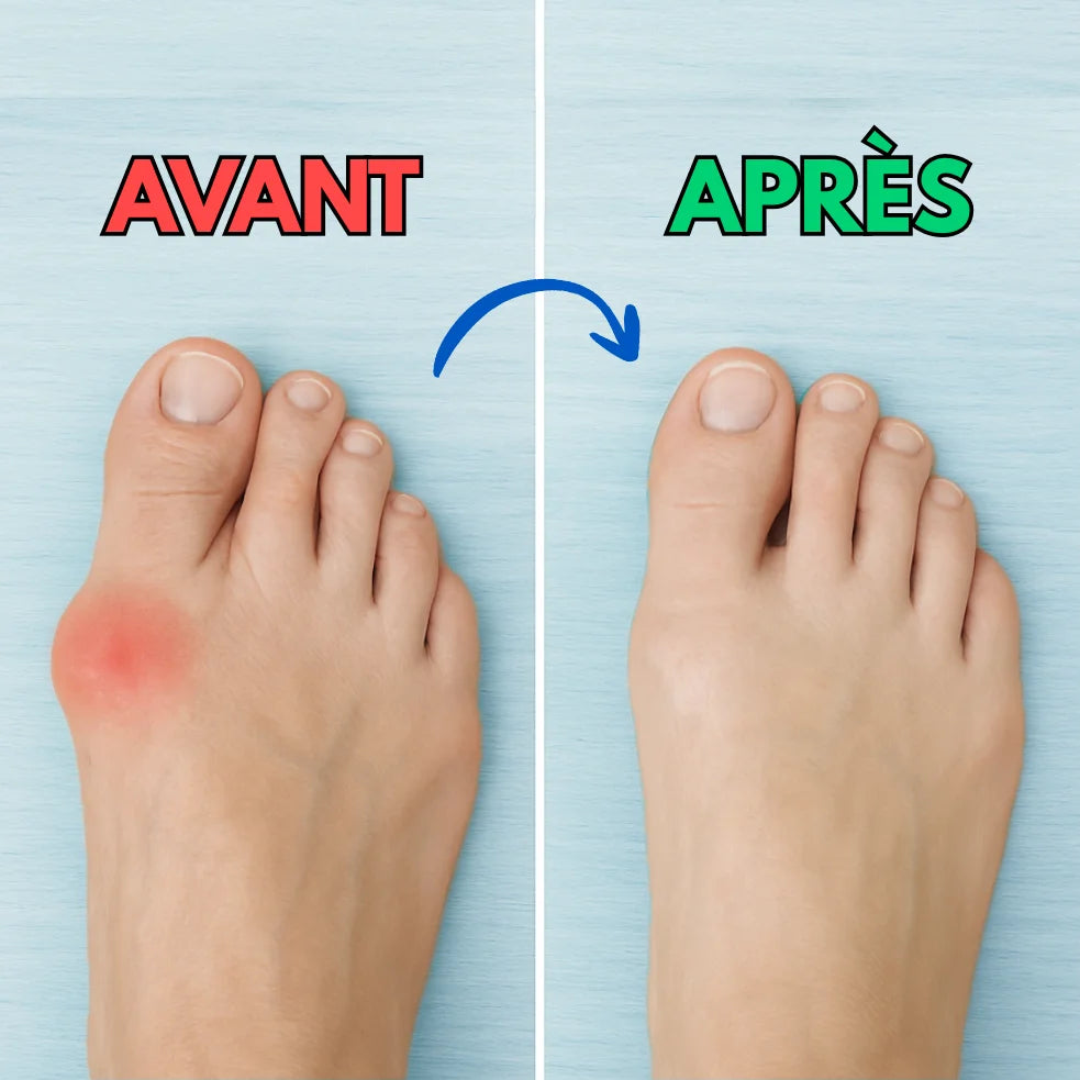 ConfortFlex® – Plus de douleur aux pieds en 14 jours - Semelles pour l’hallux valgus et la voûte plantaire - Nuage Confort
